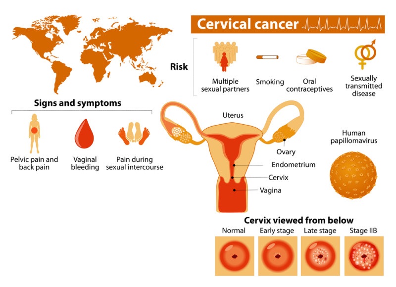 cervical cancer info