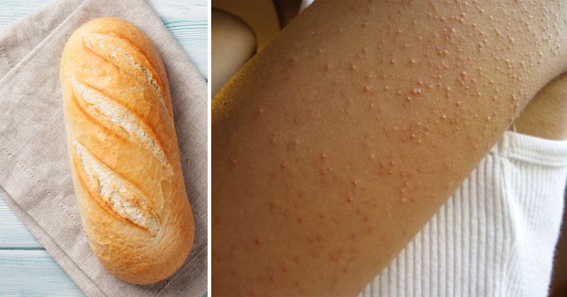 Аллергия На Глютен Симптомы Диета