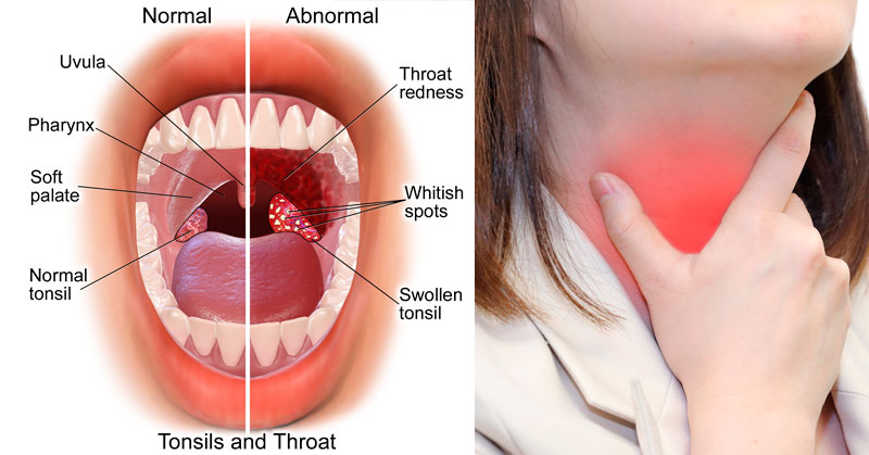 tonsils-sore-throat
