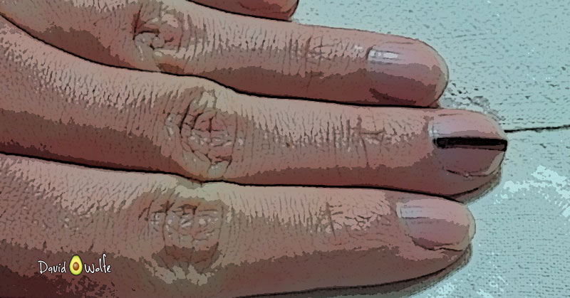 melanoma-finger