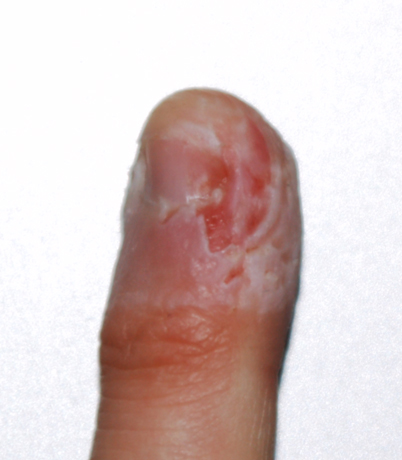 Finger biting dermatophagia