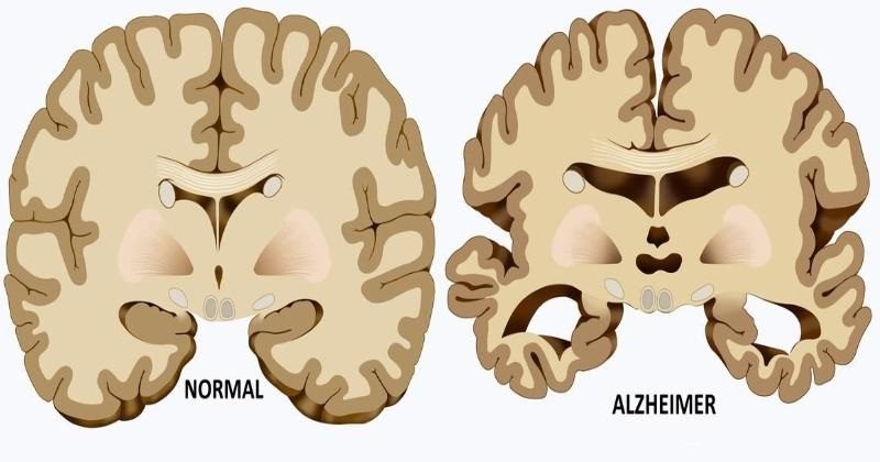 Resultado de imagem para alzheimer