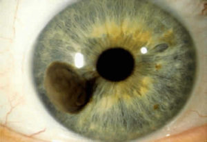 Do You Have a Spot on Your Iris? THIS is What it Means! - David Avocado