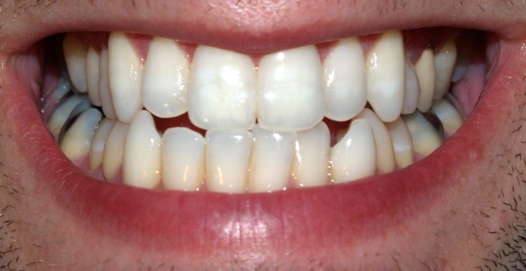 Teeth_by_David_Shankbone acidic