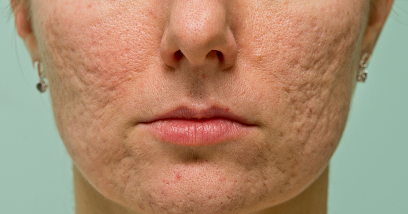 acne scars FI