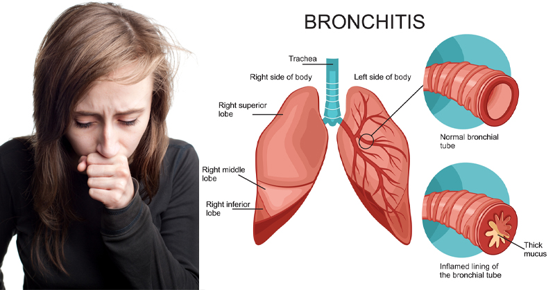 bronchitis remedies FI