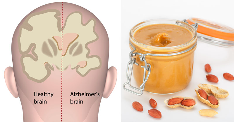 peanut butter diagnose Alzheimer's disease FI