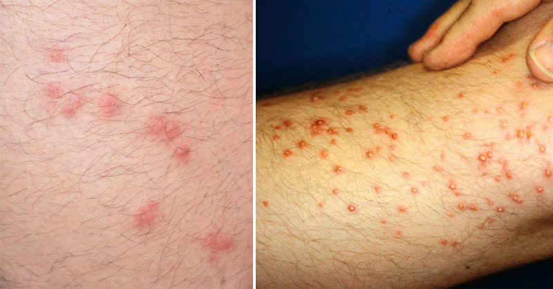 bug bites that itch and burn