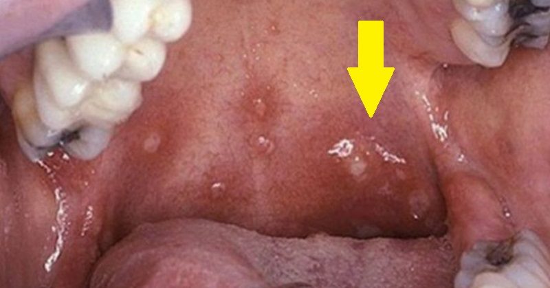herpes images in mouth