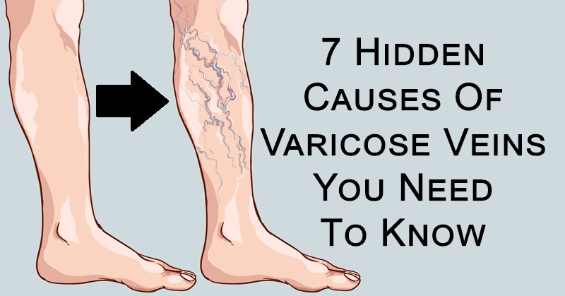 causes varicose veins FI