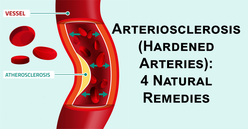 Arteriosclerosis FI