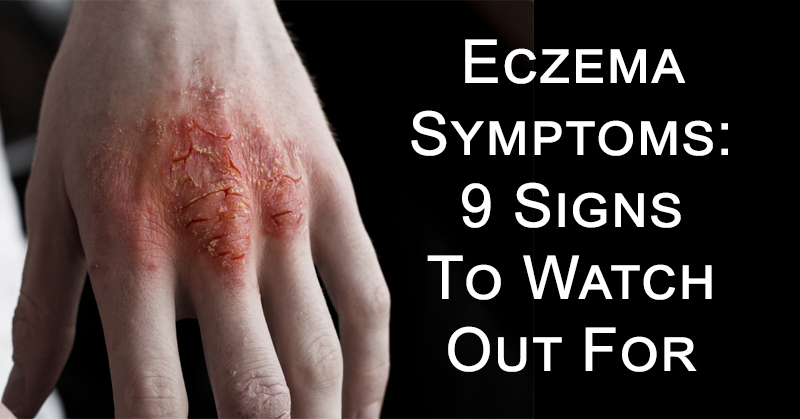 eczema symptoms FI