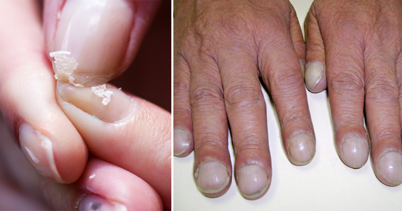 fingernails health FI02
