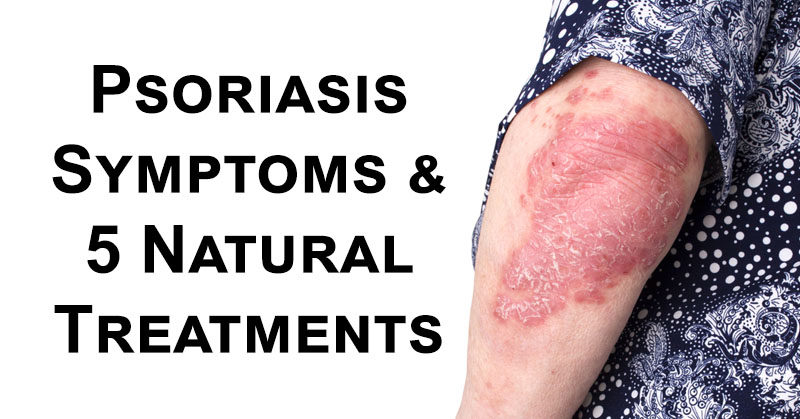 Psoriasis Symptoms And 5 Natural Treatments
