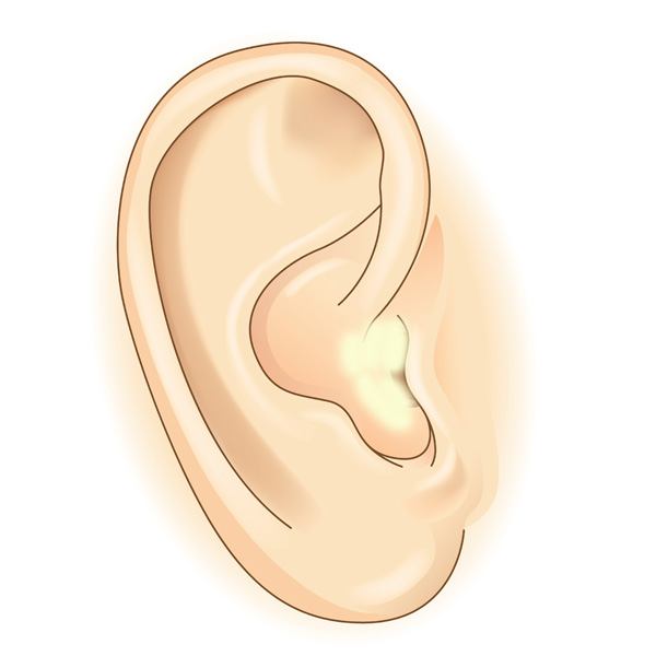 earwax health