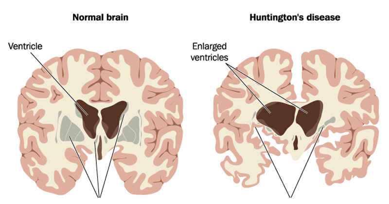 huntingtons disease pictures
