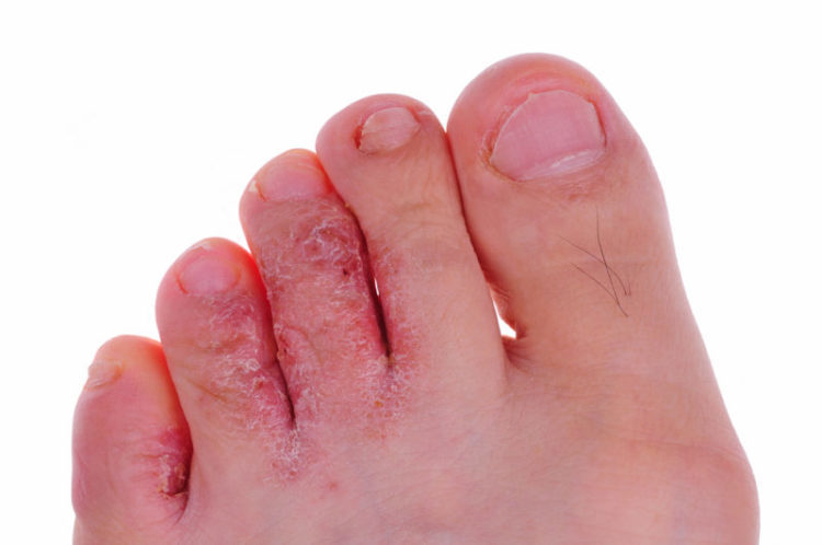 Tagetes essential oil athlete's foot